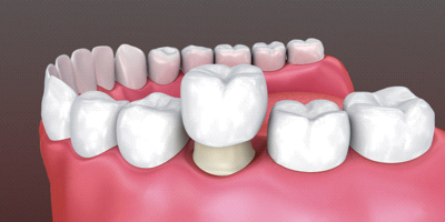 Базальная имплантация зубов Томск Северо-Каштачный 2-й plasmolifting в стоматологии
